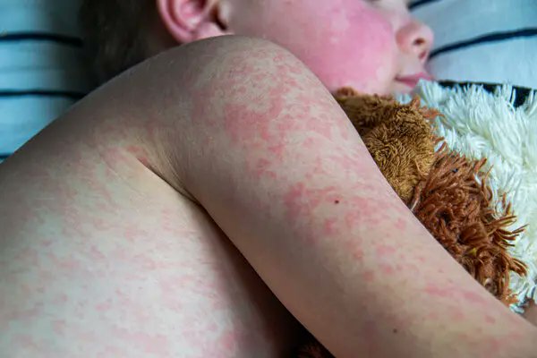 BREAKING: Measles Surge 28% in a Week—Vaccination Debate Escalates!