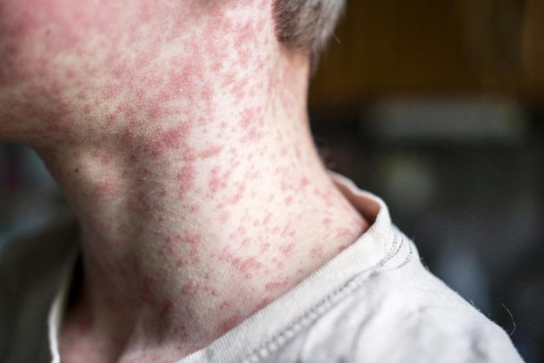 WHO Warns: Texas Measles Outbreak Linked to New Mexico & Kansas!
