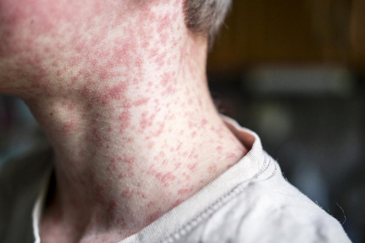 WHO Warns: Texas Measles Outbreak Linked to New Mexico & Kansas!