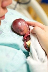 Controversial Claim: Miscarried Babies Like Walter Are Aborted Daily!
