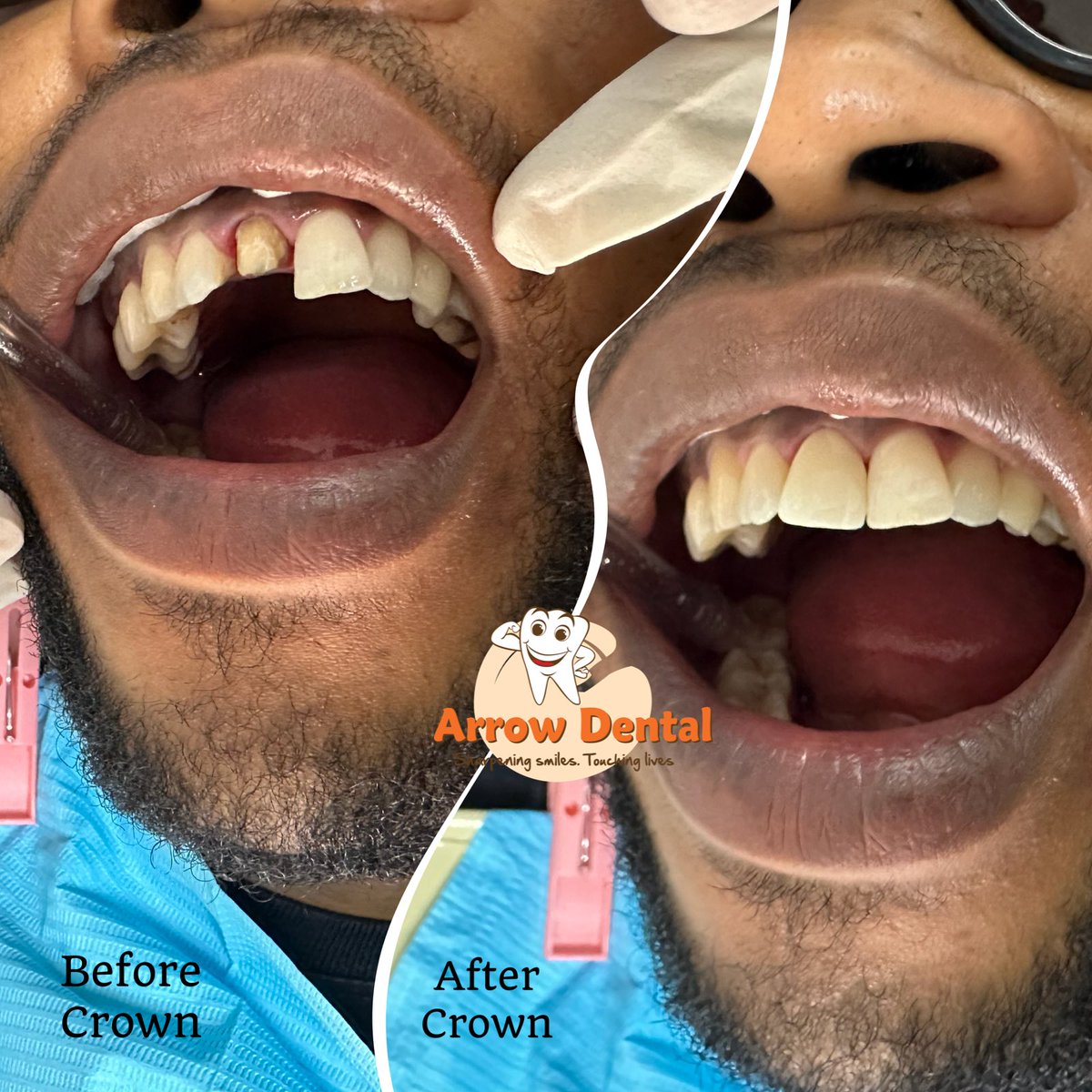Shocking Truth: 90% of Root Canals Demand a Crown—Why?