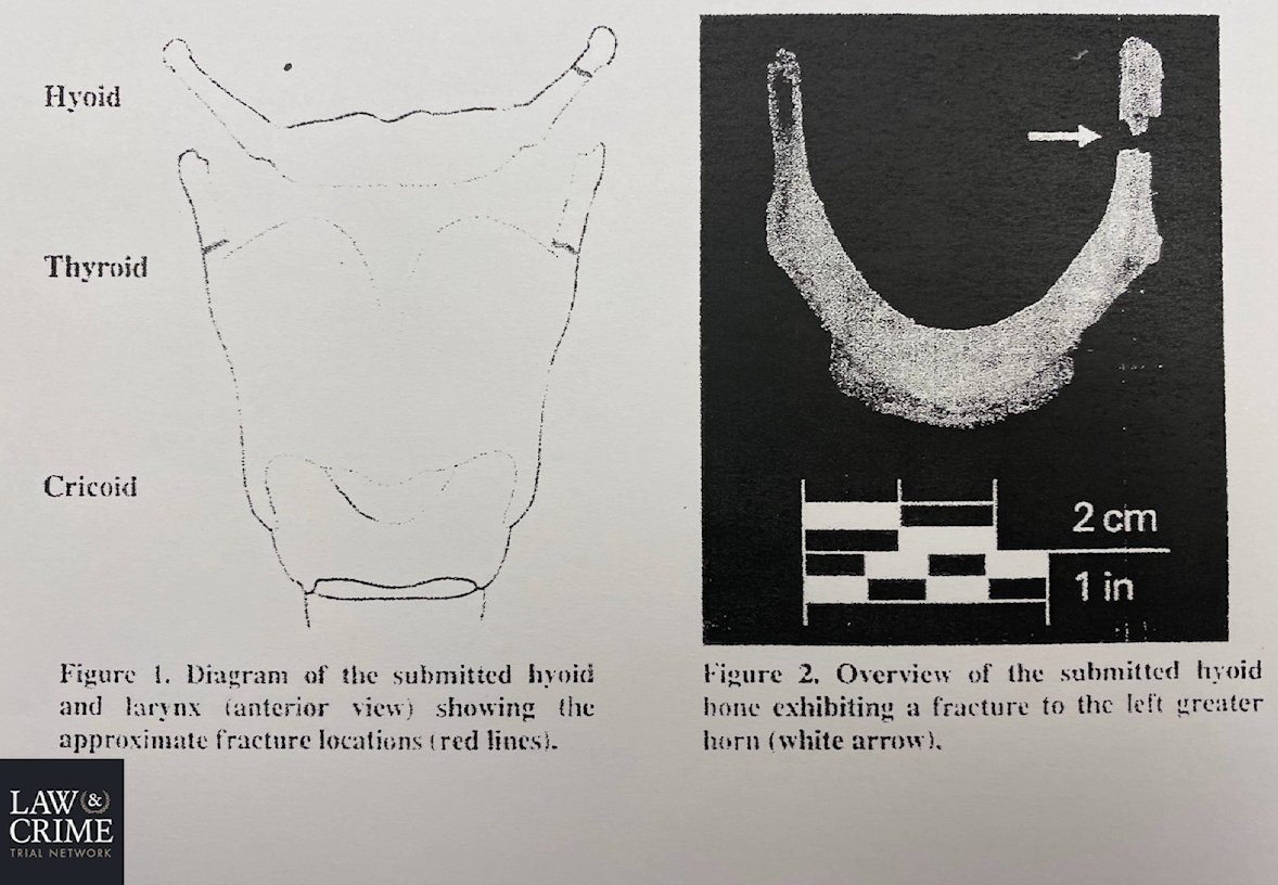 Shocking Epstein Autopsy Photo: Experts Claim Homicide Evidence!