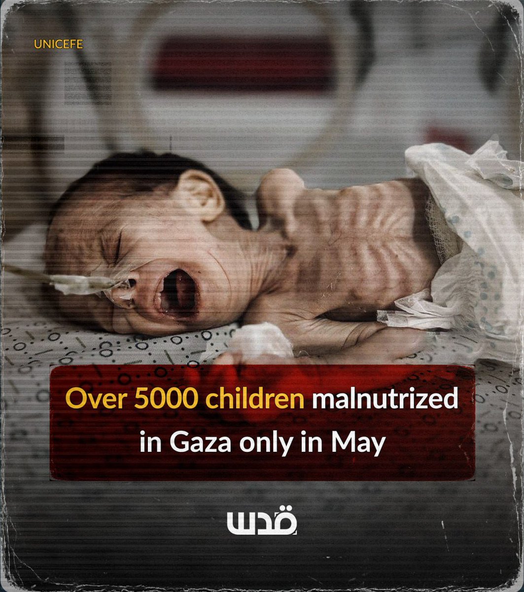 UNICEF: Gaza's Child Malnutrition Crisis Hits 5,000 in May!