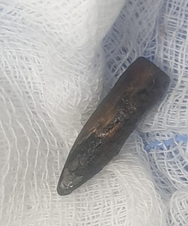 14-Month Struggle Ends: Bullet Finally Removed! —  Bullet removal surgery, Chronic pain relief solutions, Emergency medical intervention 2025