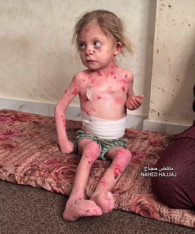 "7-year-old Nour al-Huda Hajjaj's life hangs in the balance as rare skin disease worsens - calls for urgent travel to save her and other sick children" — Nour al-Huda Hajjaj disease, urgent medical treatment, help sick children
Rare skin condition child, critical situation, medical attention needed
Child in need of urgent care, life-saving treatment, medical emergency
