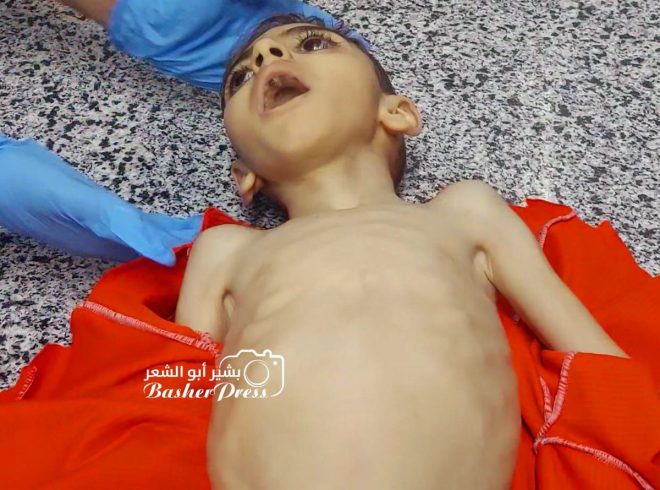 Four-Year-Old Dies in Gaza: Starvation Sparks Global Outrage — children malnutrition Gaza, humanitarian crisis Gaza 2025, Gaza occupation impact on health
