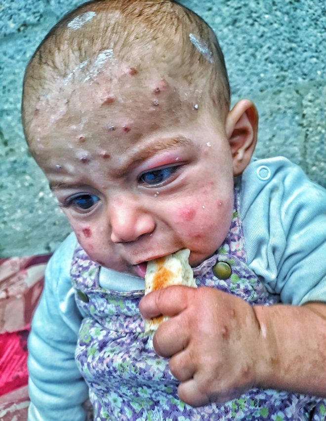 How Starvation, Pollution, and Israeli Bombing are Creating a Health Crisis in Refugee Camps! — Humanitarian crisis, contaminated water sources, inadequate healthcare provisions