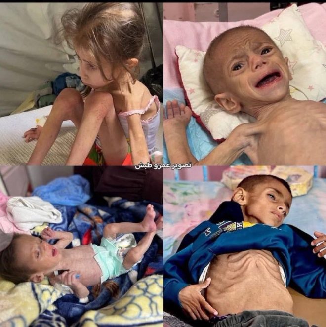 World Ignores Gaza's Child Famine: A Global Outrage Unfolds!