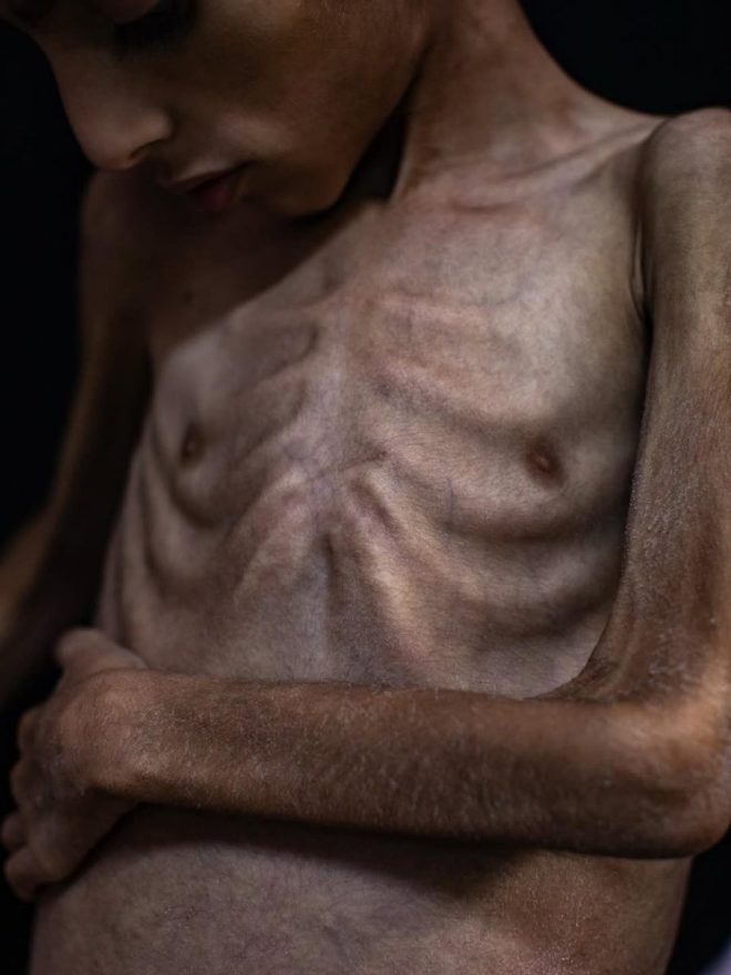 5-Year-Old Osama Al-Riqib: A Child's Fight Against Gaza's Blockade — child malnutrition crisis Gaza, humanitarian impact on children Gaza 2025, weight loss in young children Gaza