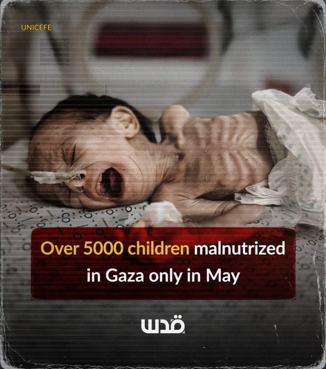 5,000 Gaza Kids Malnourished: Is War the Real Enemy? — malnutrition crisis Gaza Strip, child hunger UNICEF report, humanitarian emergency children Gaza 2025