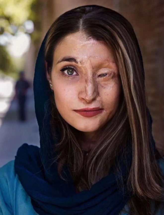 "Brave Iranian Woman Attacked with Acid for Defying Hijab Mandate - Shocking Reality for Women in Iran" — Iranian acid attack victim, Women's rights in Iran, Hijab protest incident