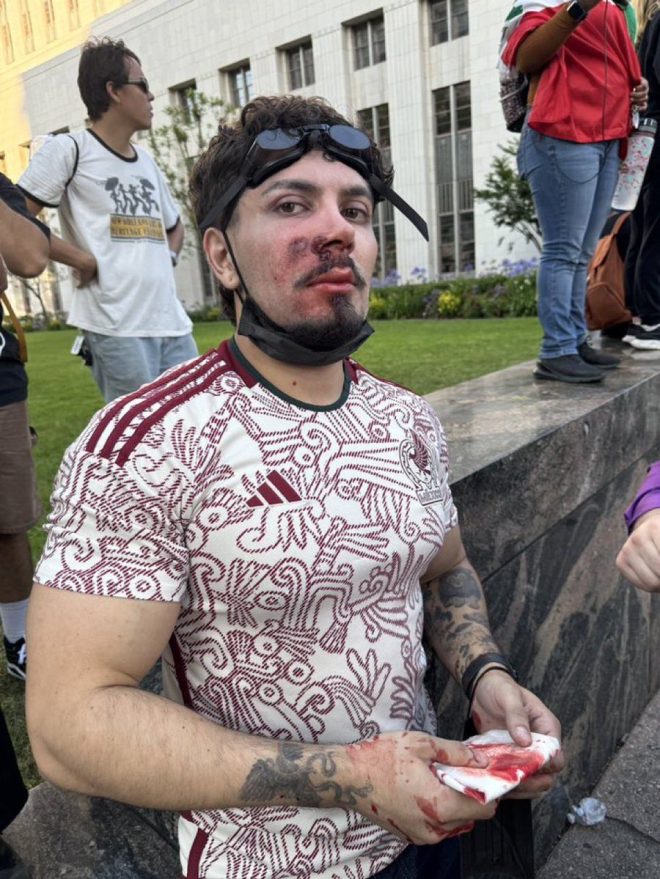 Democrats Outraged: Antifa Agent Hit in Face with Non-Lethal Round! — Antifa protests news, Non-lethal weapon incidents 2025, Political violence reactions