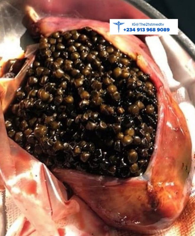 Gallstones: The Silent Threat Hiding in You! — Gallbladder health, Silent gallstone symptoms, Pancreatitis risk factors 2025