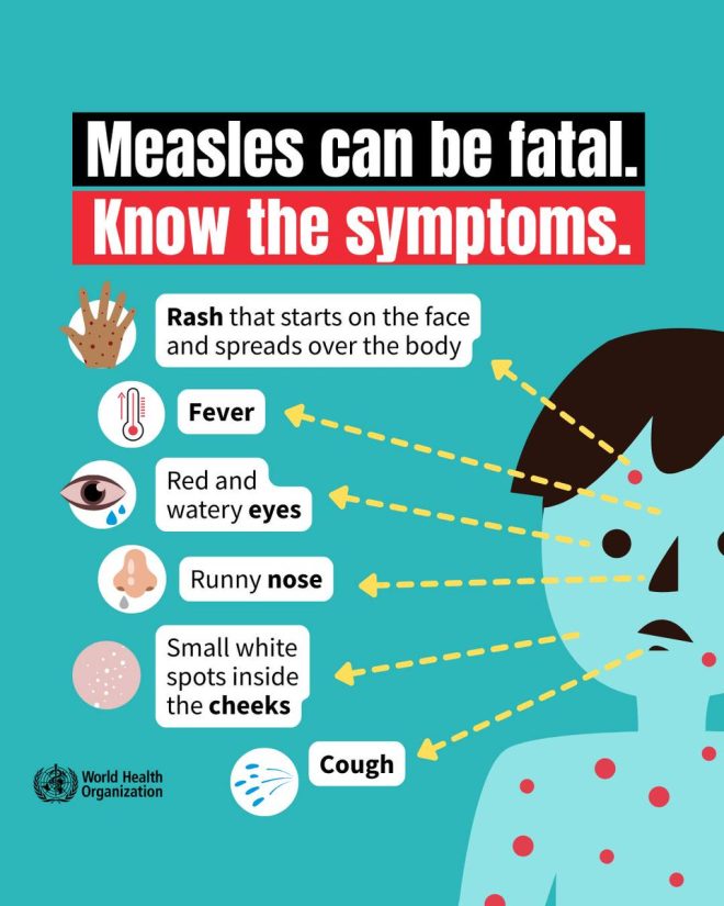 Measles Outbreak: Are We Ignoring the Signs? — measles symptoms and treatment, prevent measles outbreak 2025, complications of measles in children
