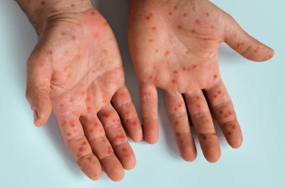 Mpox Still a Global Emergency: Why Ignore It? — global health crisis, mpox outbreak updates, infectious disease awareness