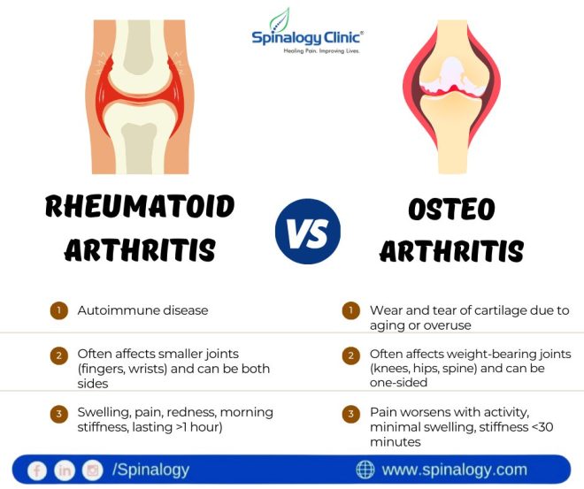 RA vs OA: The Shocking Truth You Didn't Know! —  Autoimmune Joint Disorders, Degenerative Joint Disease, Chronic Inflammatory Arthritis