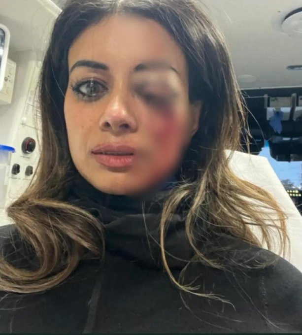 Shocking Attack: Iranian Woman's Eye at Stake for Protesting! — Iranian protest violence, morality police brutality, women’s rights protests Australia