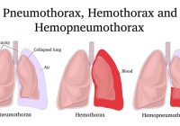 Shocking Chest Injuries: Air vs. Blood Battles! —  lung collapse treatment, pleural effusion causes, chest trauma management