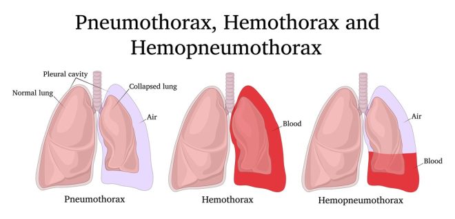 Shocking Chest Injuries: Air vs. Blood Battles! — lung collapse treatment, pleural effusion causes, chest trauma management