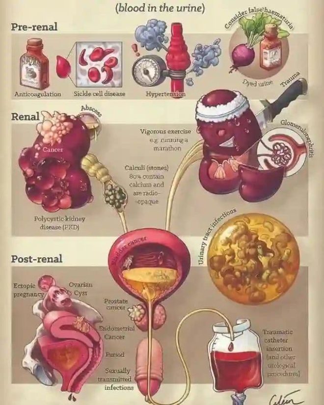 Shocking Hematuria Findings: Is Your Water Toxic? — blood in urine causes, urinary tract infection symptoms, kidney disease diagnosis 2025