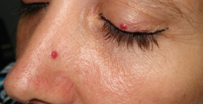 Shocking Secrets: What Your Cherry Angiomas Reveal! — benign vascular tumors, skin growths treatment, vascular birthmarks 2025