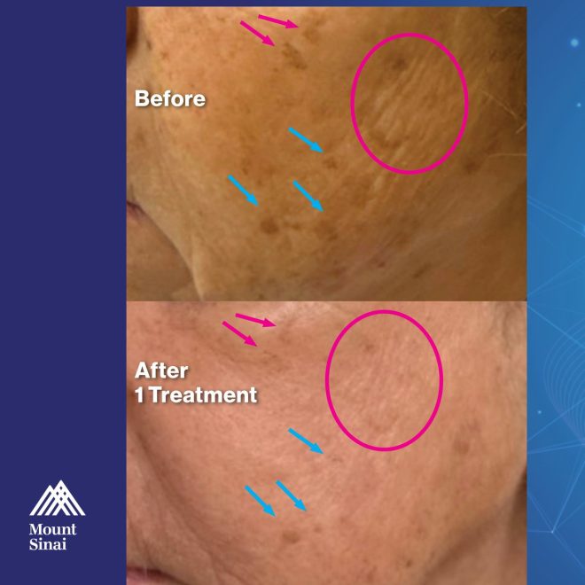 Shocking Skin Secrets: Can Fraxel Really Erase Spots? — Brighten Skin Naturally, Advanced Pigmentation Solutions, Non-Invasive Skin Renewal Techniques