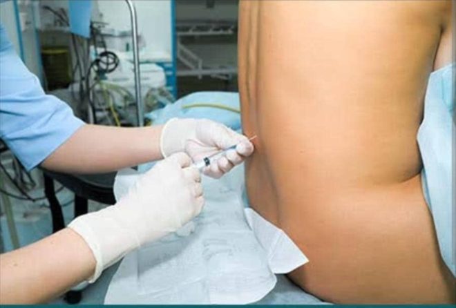 Shocking Spinal Anesthesia: Pain-Free Surgery or Risky Gamble? —  spinal block technique, epidural analgesia benefits, regional anesthesia procedures