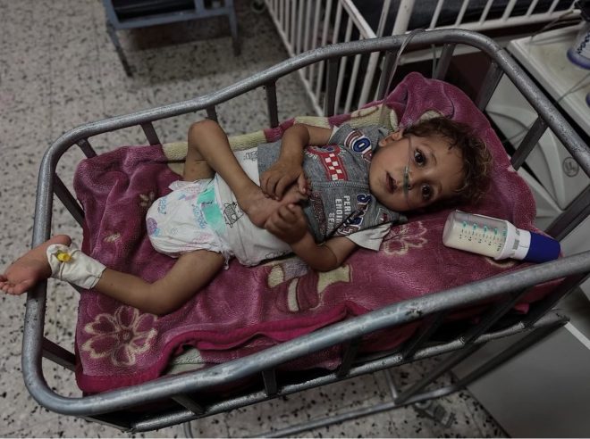 Shocking Tragedy: Gaza's Children Face Dire Health Crisis — child malnutrition crisis, Gaza humanitarian disaster, pediatric health emergency 2025