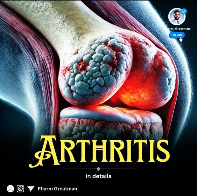 Shocking Truth: Arthritis Myths Debunked! — Understanding Joint Pain, Comprehensive Arthritis Guide, Managing Chronic Inflammation
