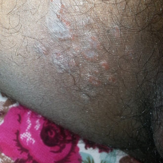 Shocking Truth: Jock Itch Outbreak Hits Men Hard! — Fungal skin infection treatment, Groin rash prevention, Tinea corporis symptoms