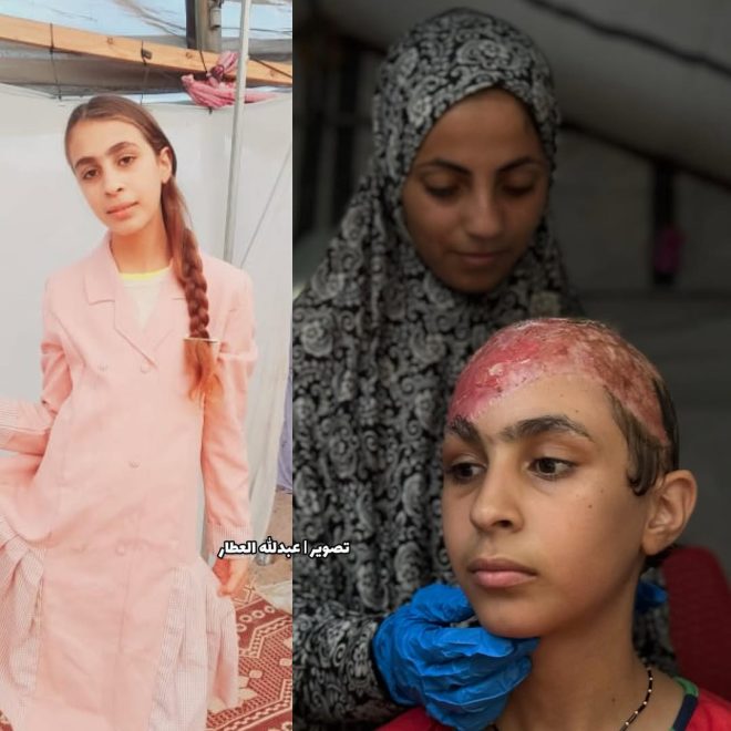 12-Year-Old Girl Injured by Airstrike: Gaza's Silent Crisis — Gaza airstrike injuries, children affected by conflict 2025, medical blockade in Gaza