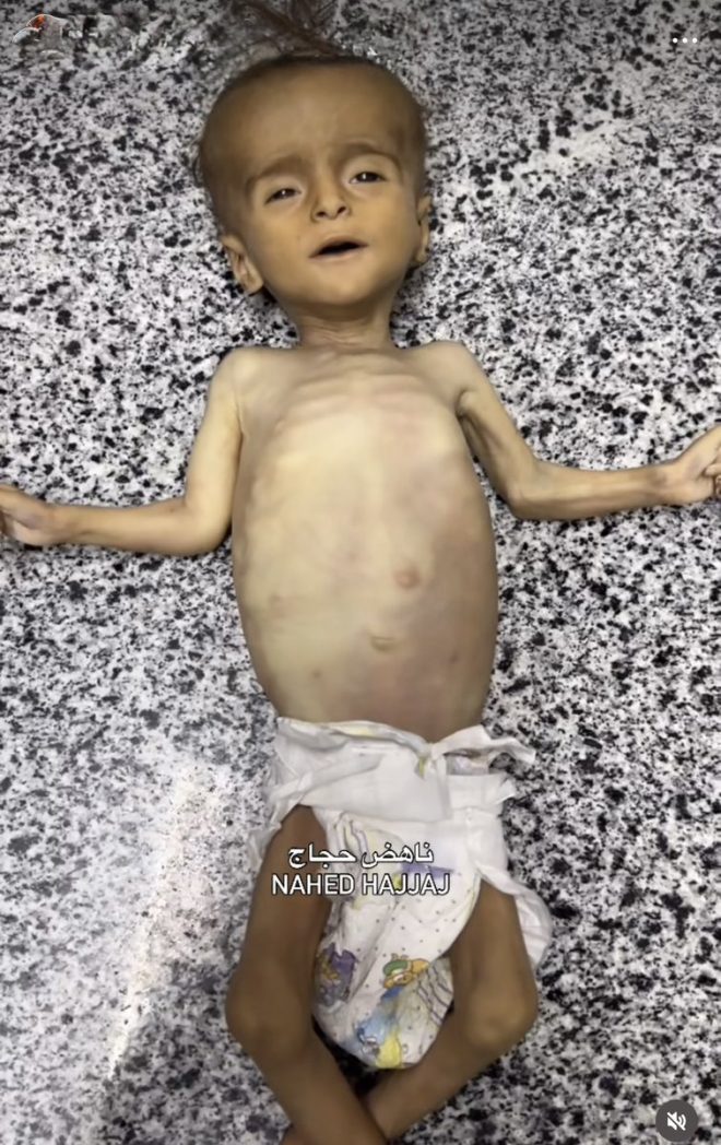 Tragedy in Gaza: Baby Dies as Supplies Are Blocked — child malnutrition crisis, Gaza humanitarian emergency, Israel blockade impact