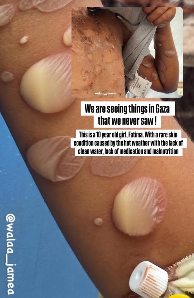 10-Year-Old Girl's Skin Condition Sparks Outrage! — rare skin conditions in children, impact of climate on health, access to clean water and nutrition 2025