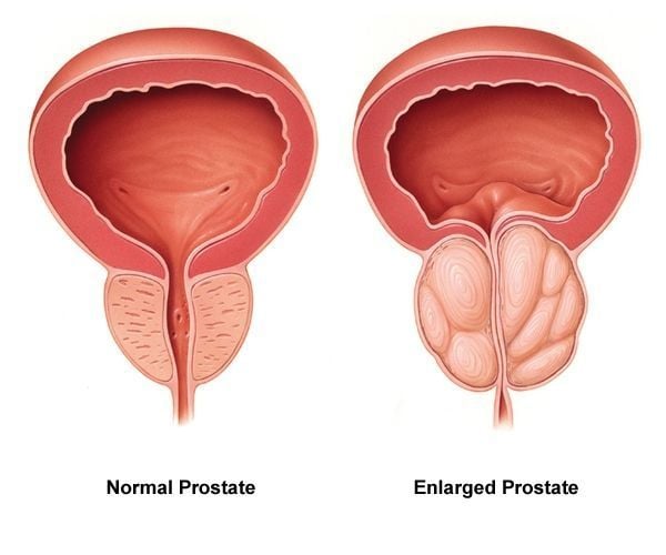 Men's Health Shock: Zinc May Save Your Prostate! —  Men's Nutrition, Prostate Health Tips, Essential Minerals for Men
