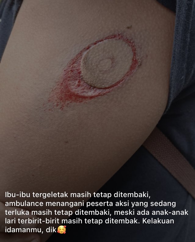 Pati's Heartbreak: Peaceful Protest Faces Tear Gas Attack! —  human rights violations, peaceful protest support, solidarity movements 2025