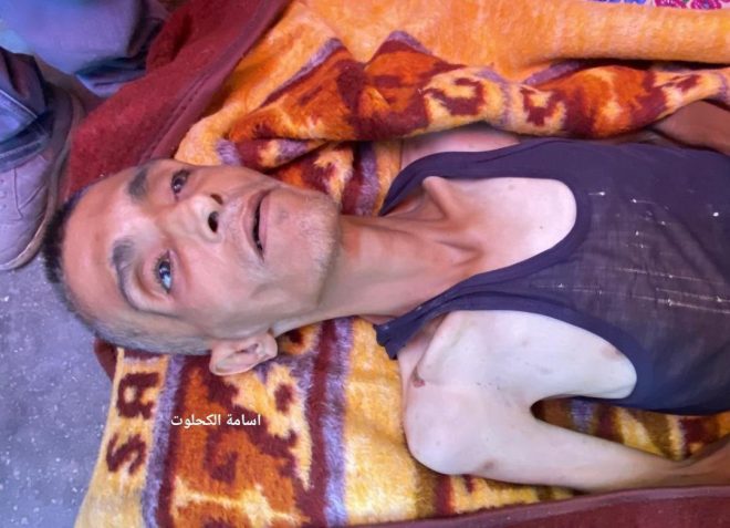 Shocking: Gaza's Famine Claims 11 Lives in a Day! —  Gaza famine crisis, malnutrition deaths Gaza, child health emergency 2025