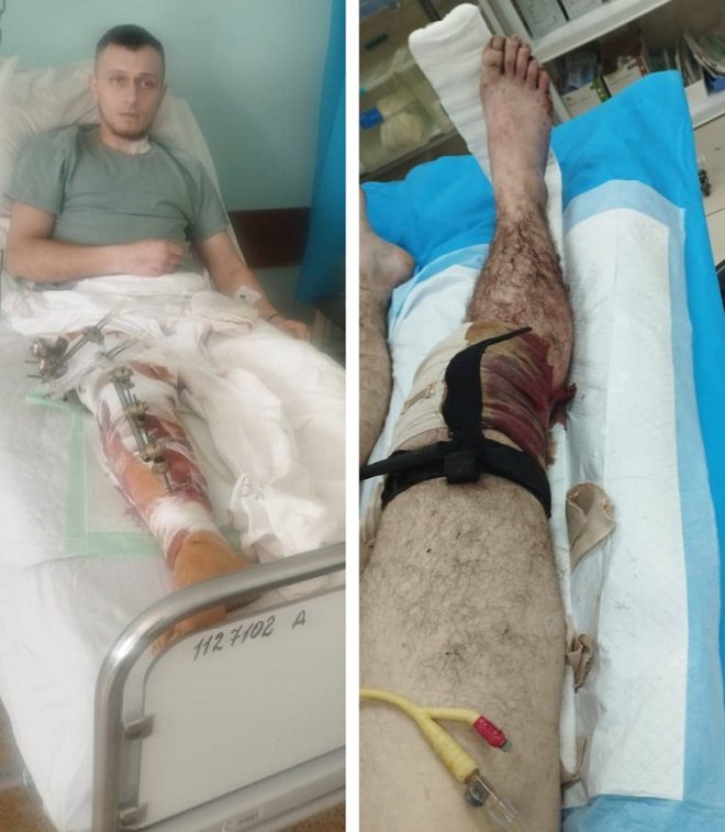 Як Андрій Синяк повертається до життя після травми? — реабілітація після травм, штучний ендопротез коліна, допомога військовим Україні
