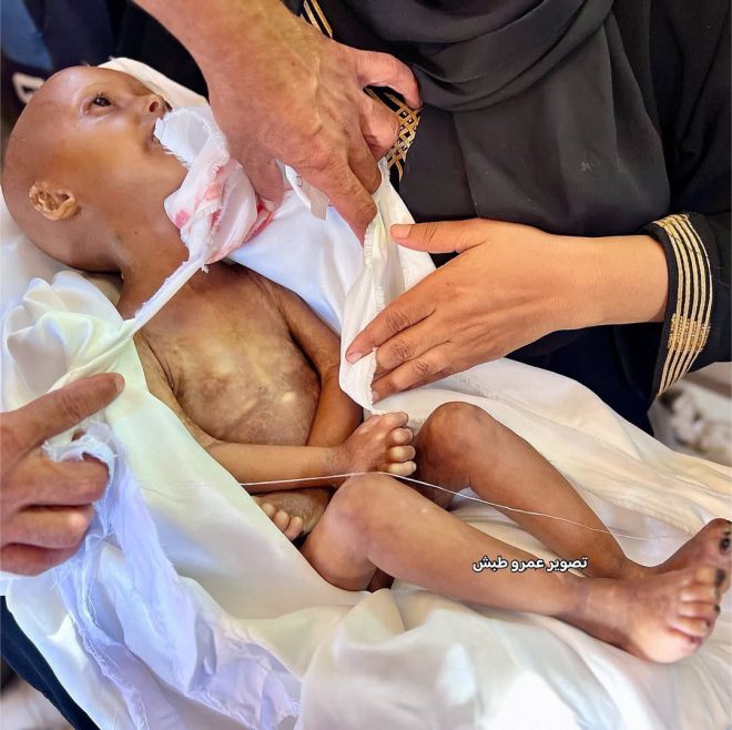 Tragic Death of 4-Year-Old Sparks Outrage Over Blockade — malnutrition crisis Gaza, children suffering Gaza blockade, humanitarian emergency Gaza 2025