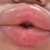 女孩突发急性寻麻疹，嘴唇肿成香肠嘴！  
她的经历让人惊讶，背后隐藏了什么？ —  女孩过敏反应, 急性皮肤病治疗, 嘴唇肿胀原因